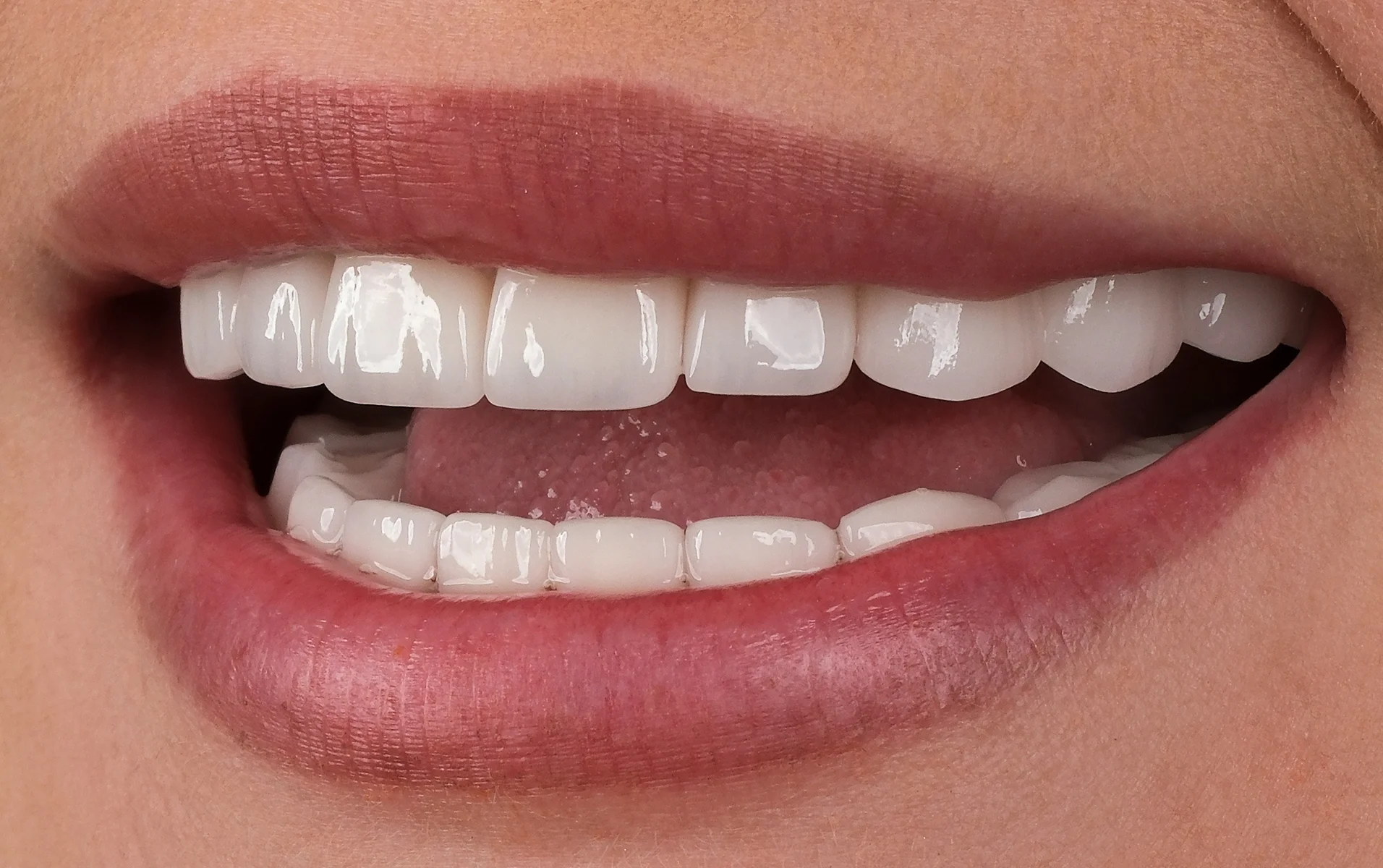 Dental implant before and after results — after