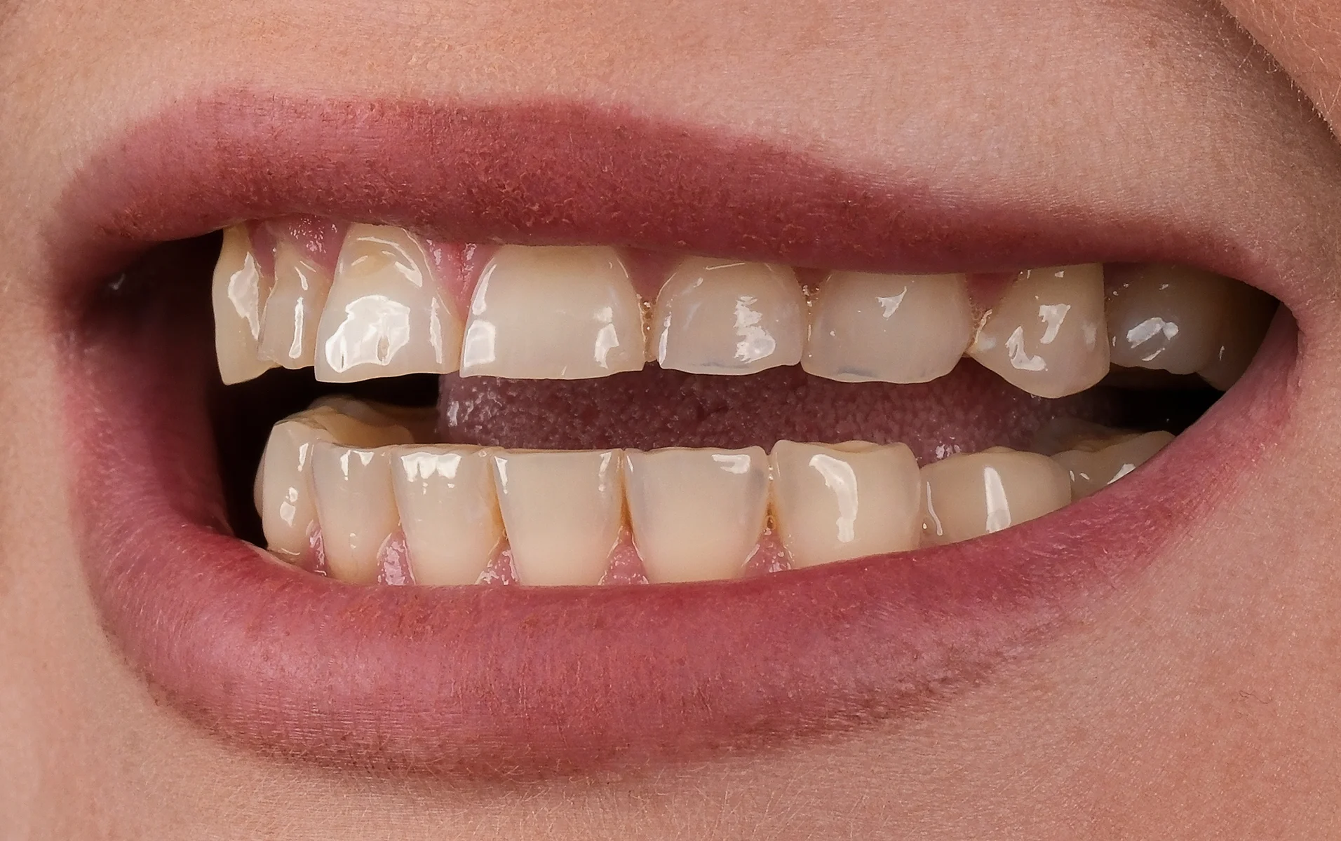 Dental implant before and after results — before
