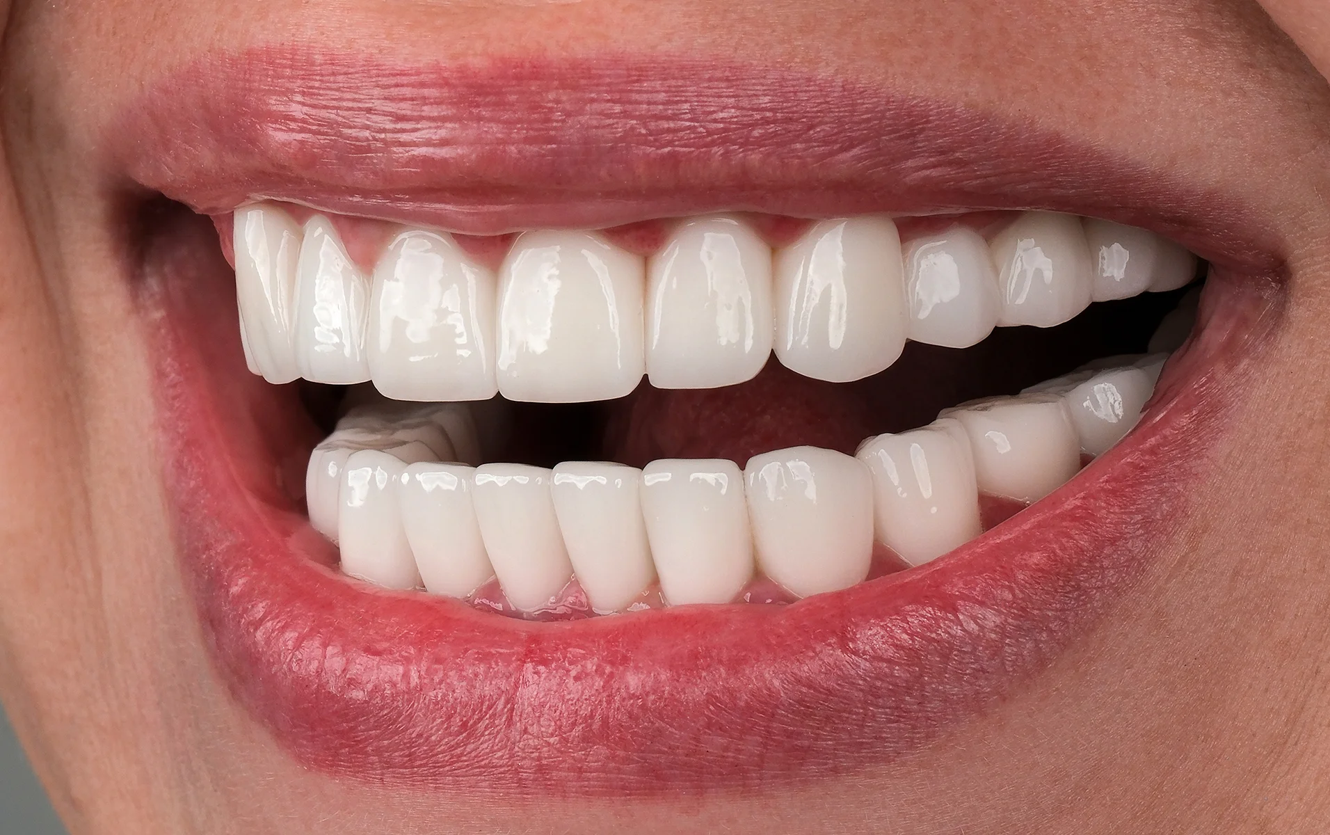 Smile Makeover After