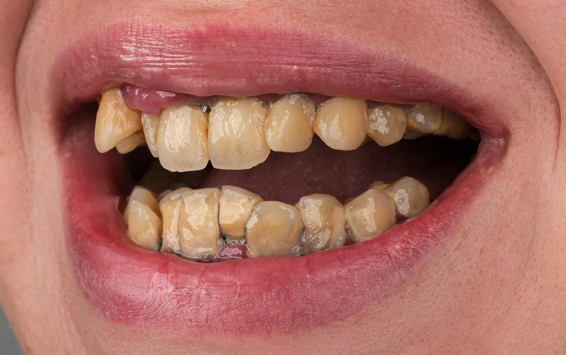 Smile Makeover Before