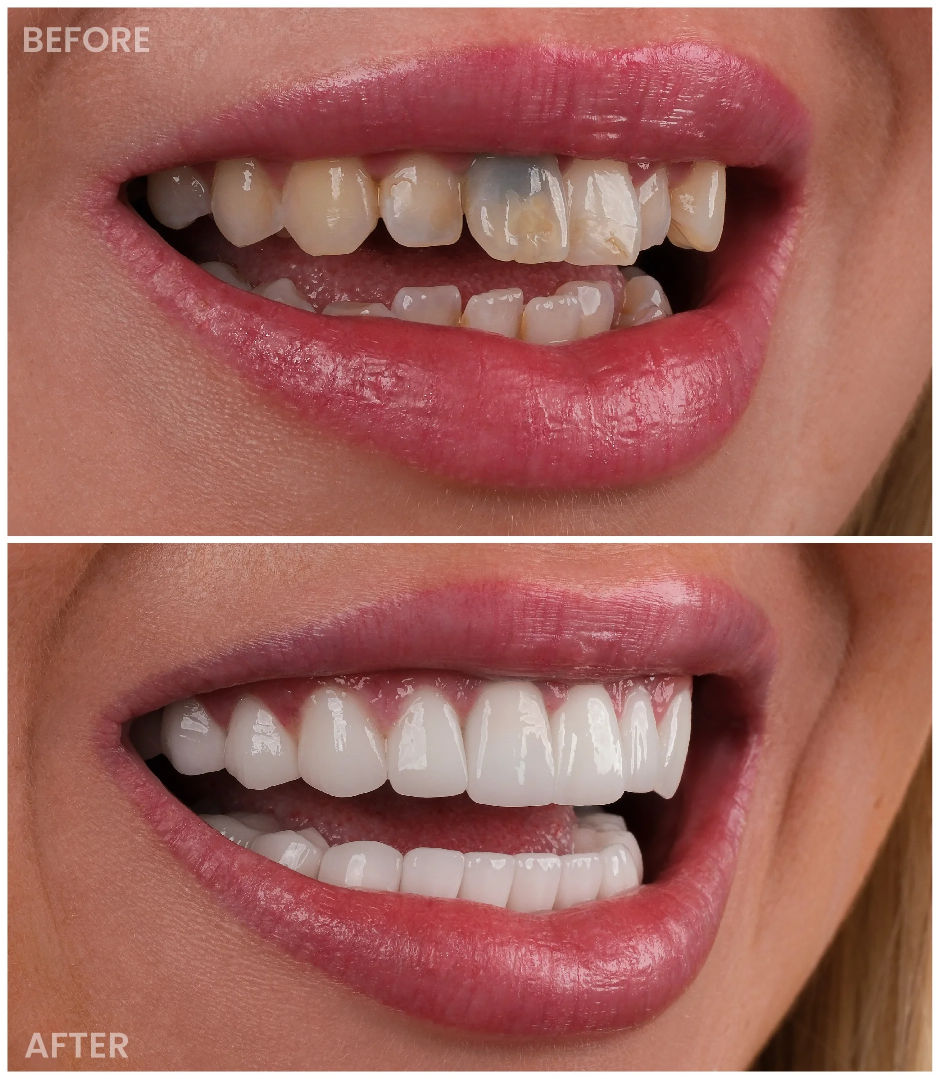 Smile Makeover