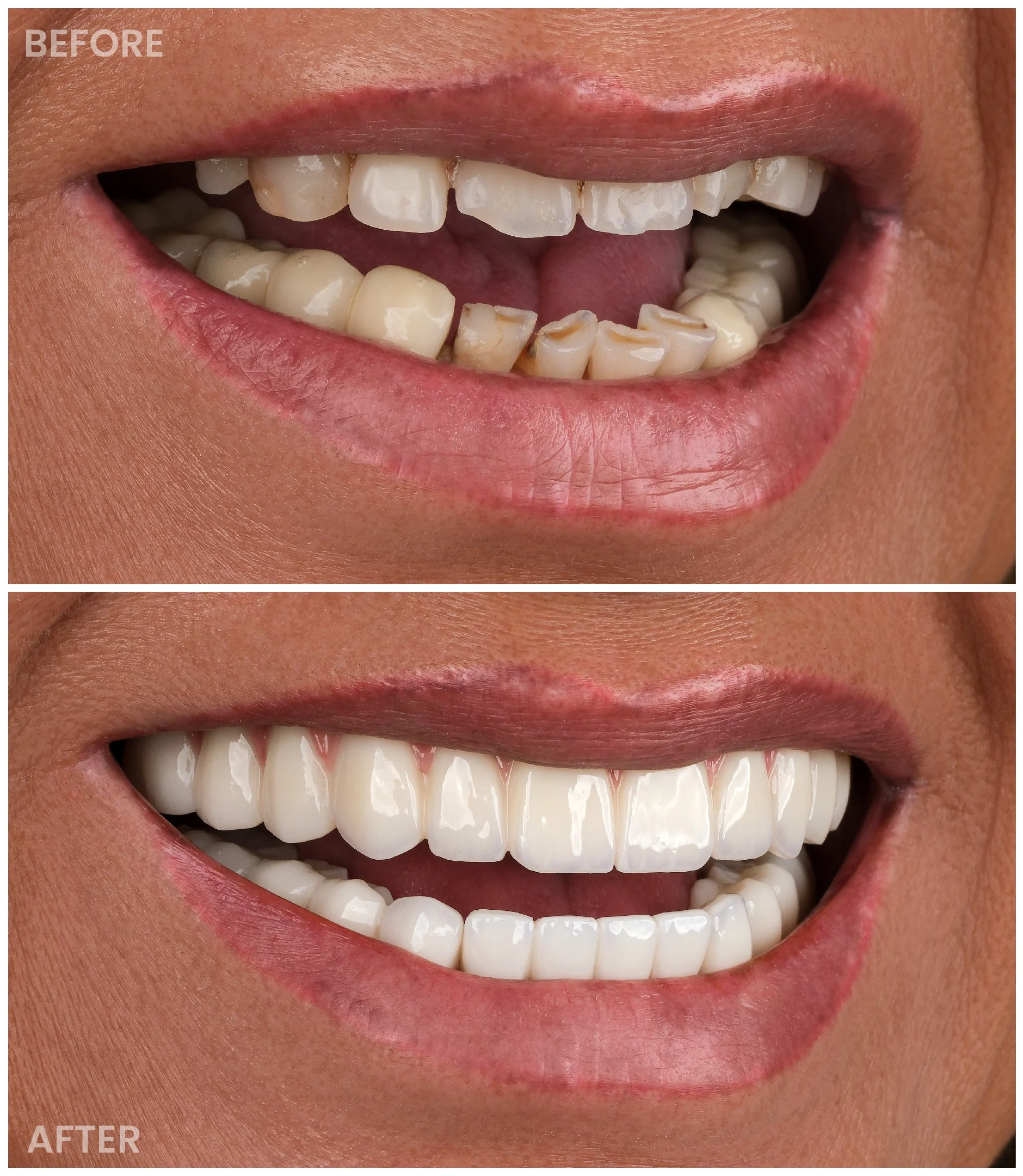 Dental Implants