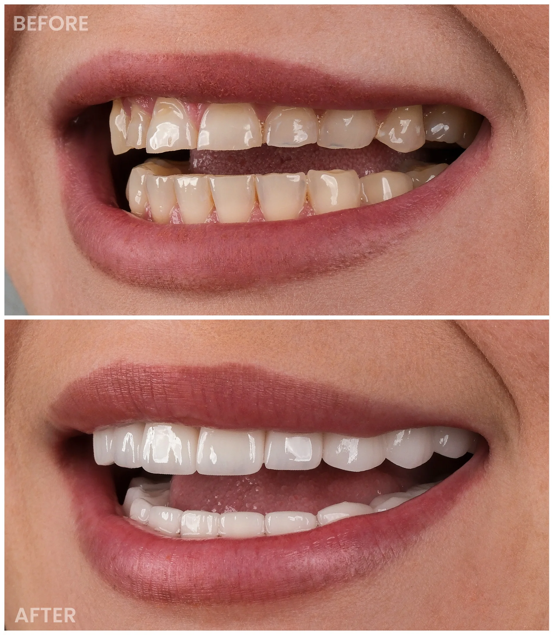 Smile Makeover