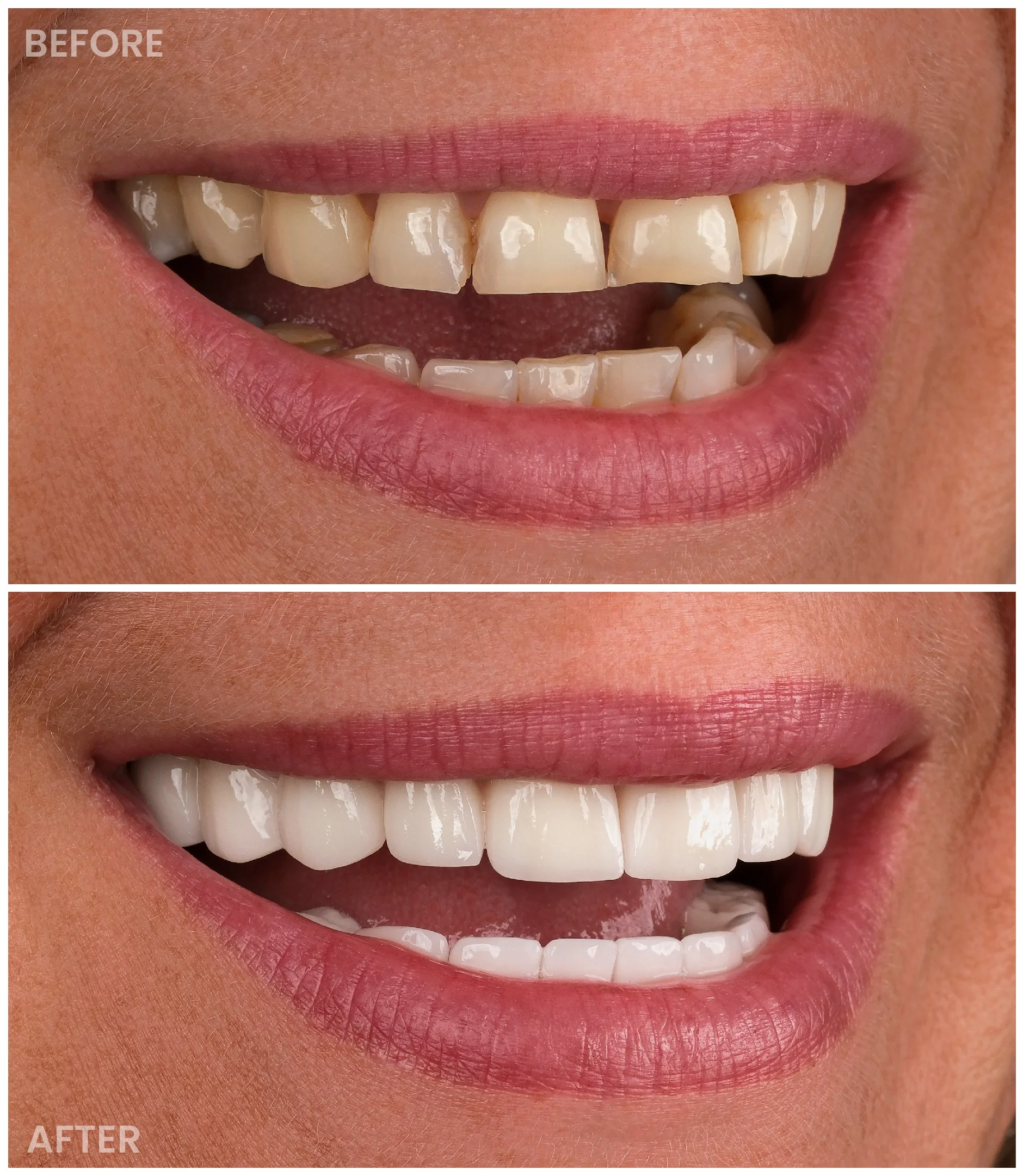 Smile Makeover