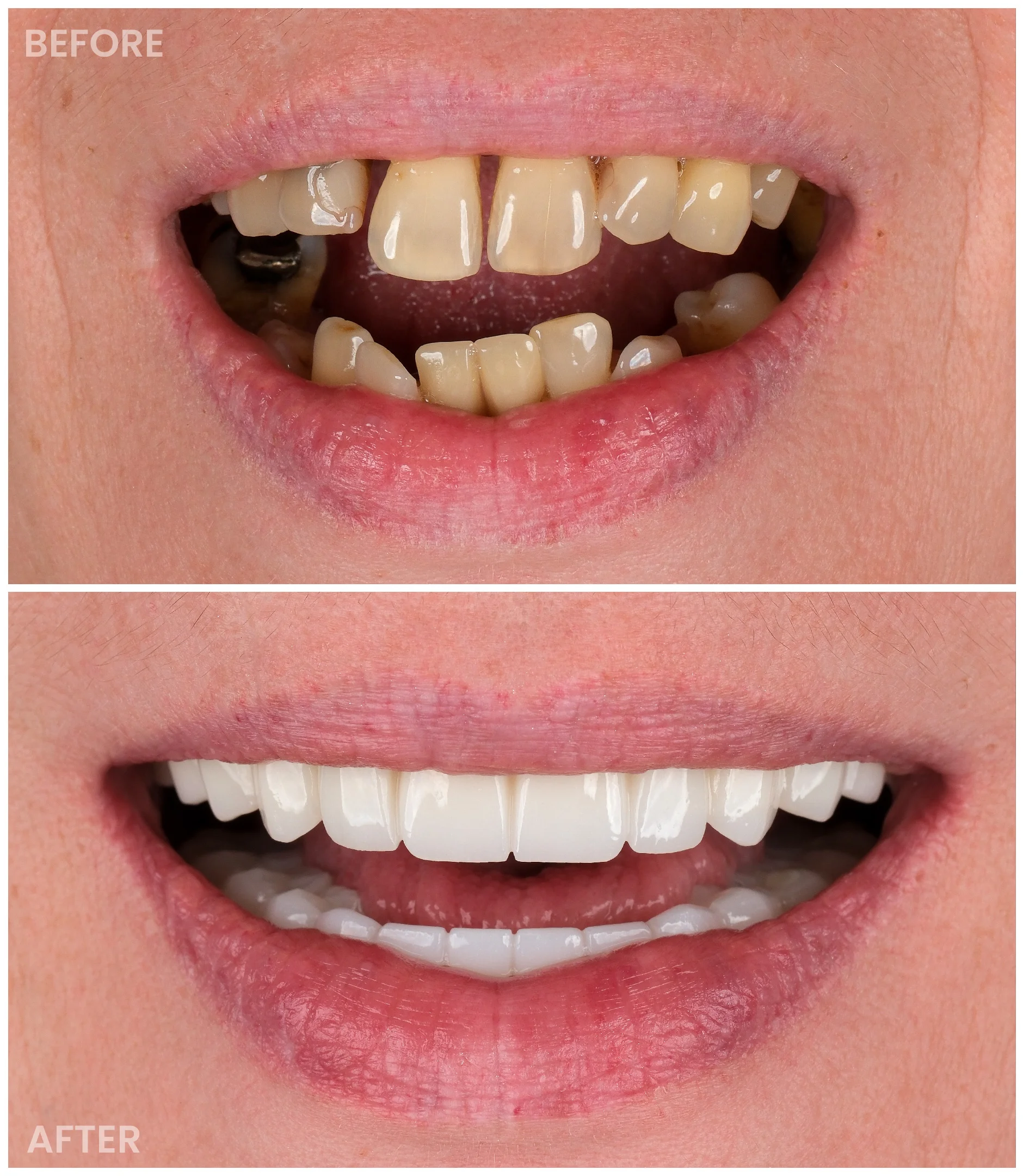 Dental Implants