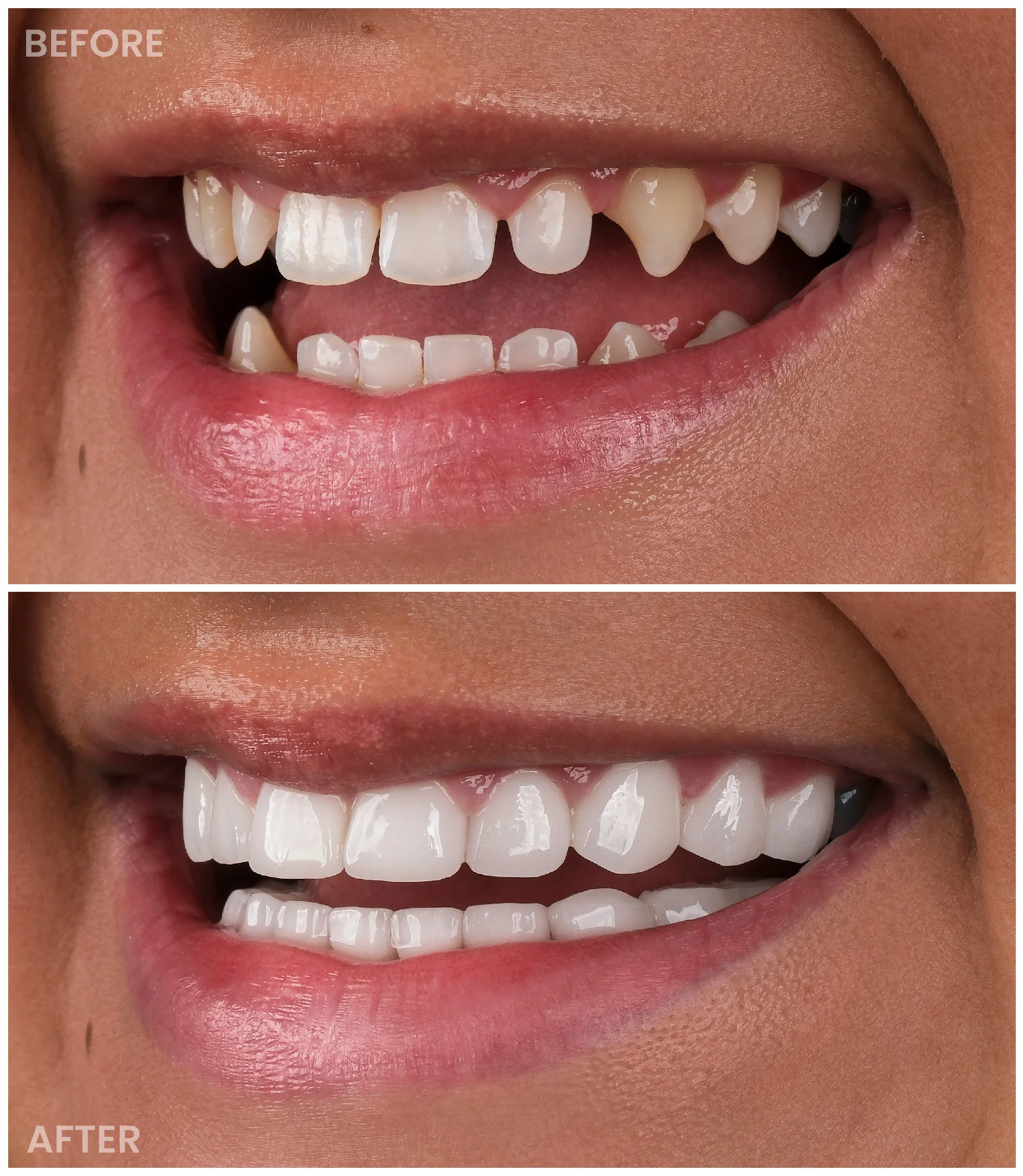 Smile Makeover
