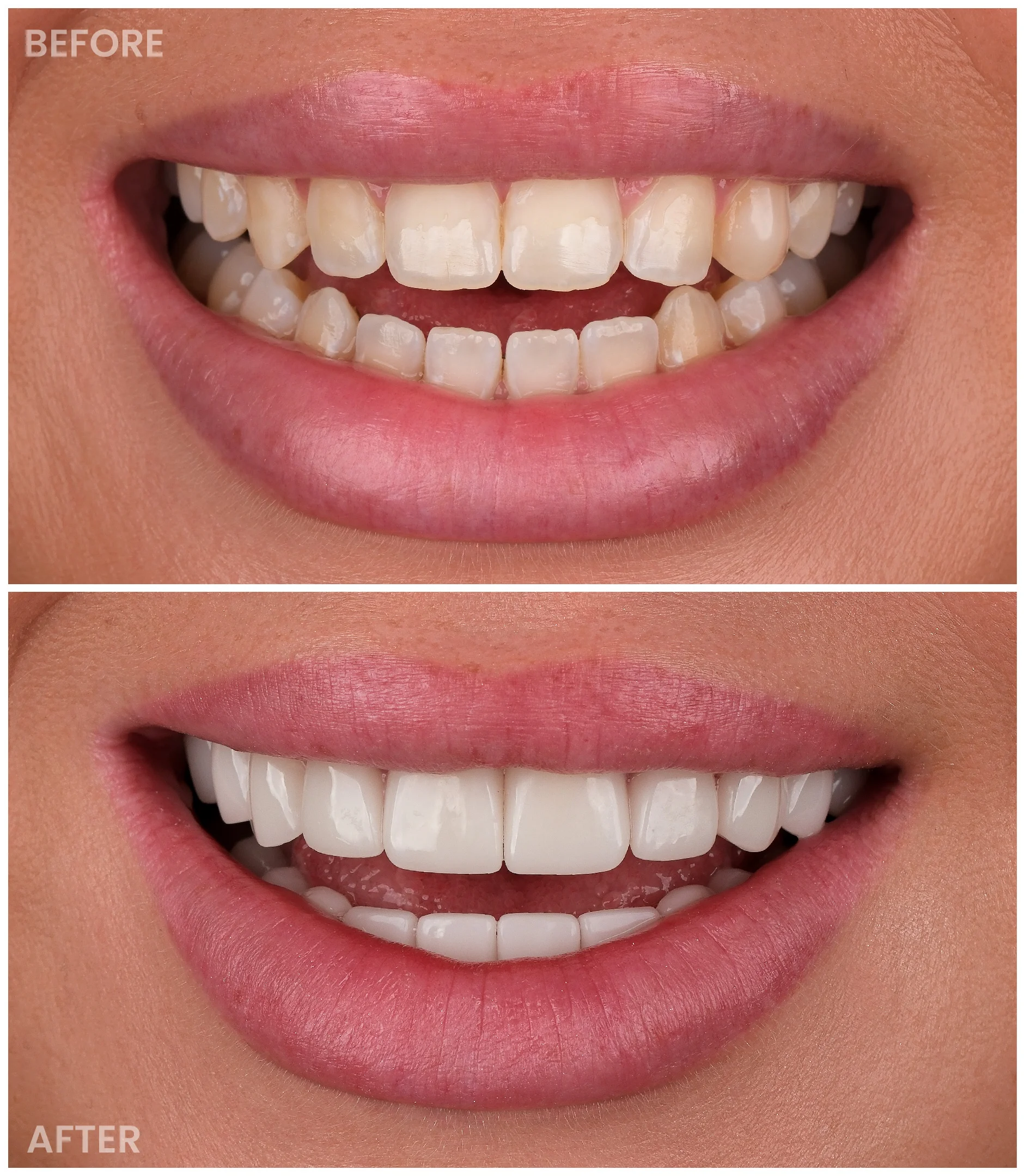 Smile Makeover
