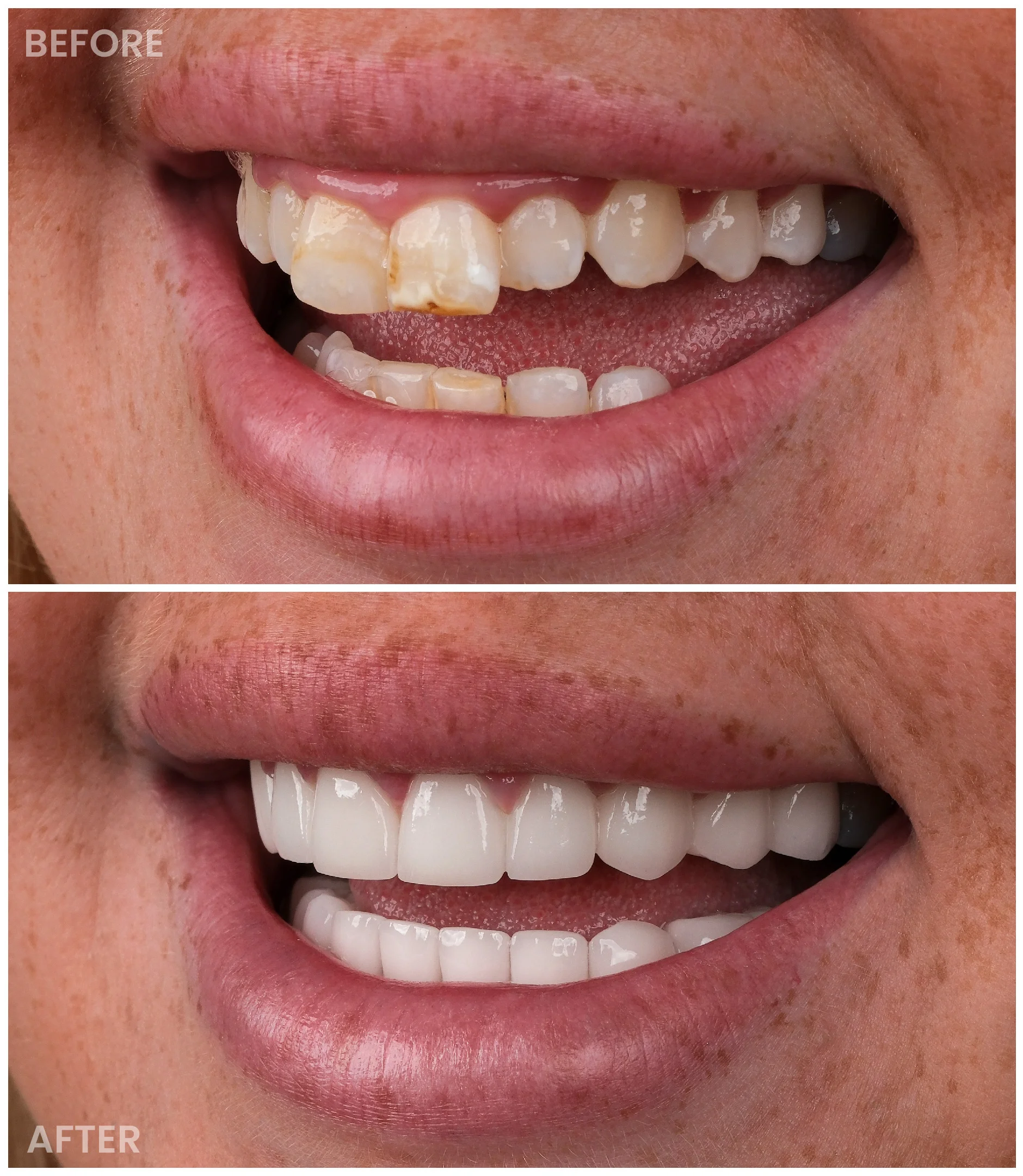 Smile Makeover