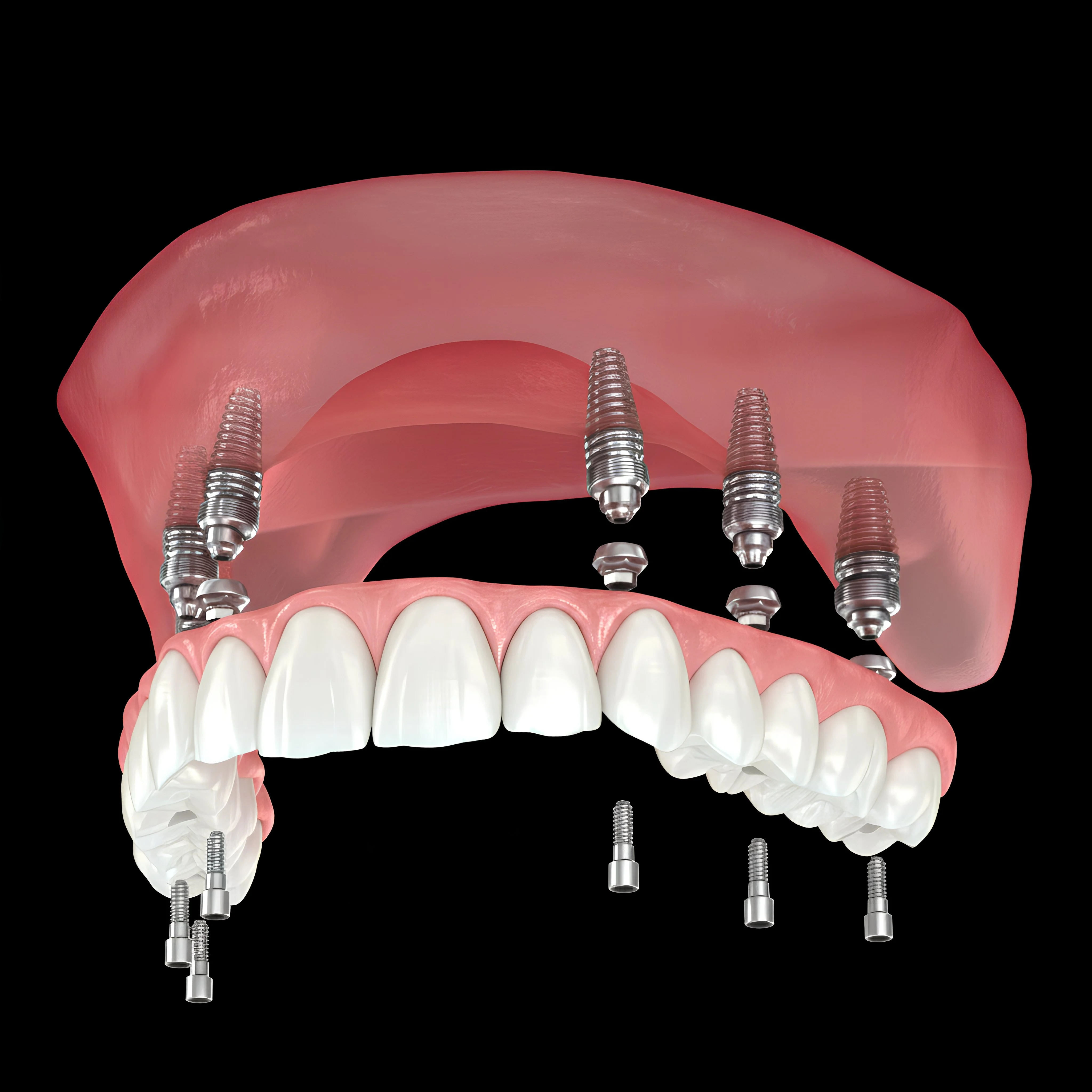 All-on-6 Implants